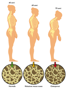 Vitamin D osteoporosis