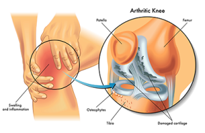 msm cartilage
