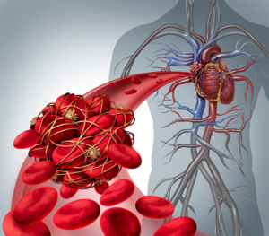 thrombosis